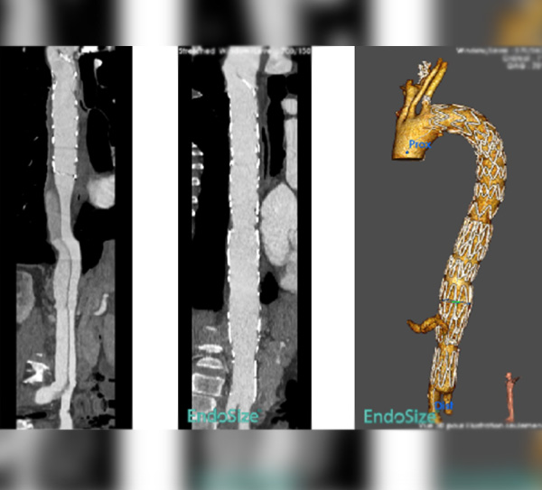 Traitement des dissections de type B