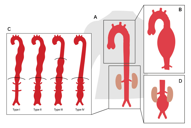 Anévrisme de l'aorte thoracique et abdominale