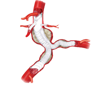 Endoprothèse aortique fenêtrée