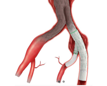 Endoprothèse branchée iliaque