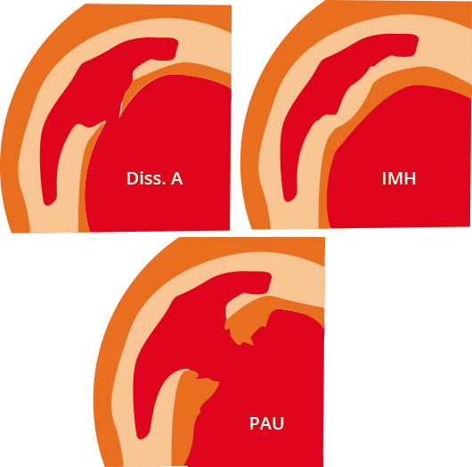 Hématome intramural (IMH) et ulcère pénétrant de l’aorte (PAU)