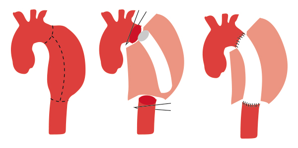 Remplacement d'un anévrisme de l'aorte thoracique par mise à plat greffe prothétique