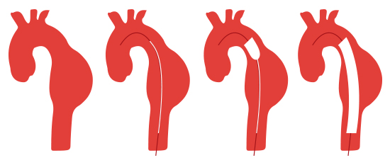 Remplacement d'un anévrisme de l'aorte thoracique par mise à plat greffe prothétique