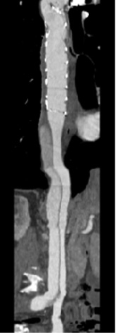 Aorte disséquée avec Flap intimal